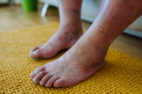 A Step Toward Health With Proper Diabetic Foot Care