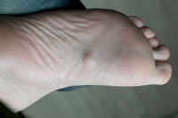 Symptoms and Causes of Plantar Fibromatosis