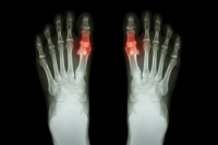 Signs and Causes of Gout