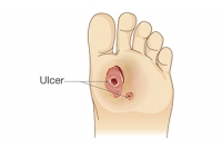 Pressure Sores Can Lead to Foot Ulcers