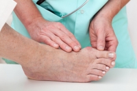 How to Manage Bunions