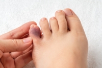 Causes of a Broken Pinky Toe